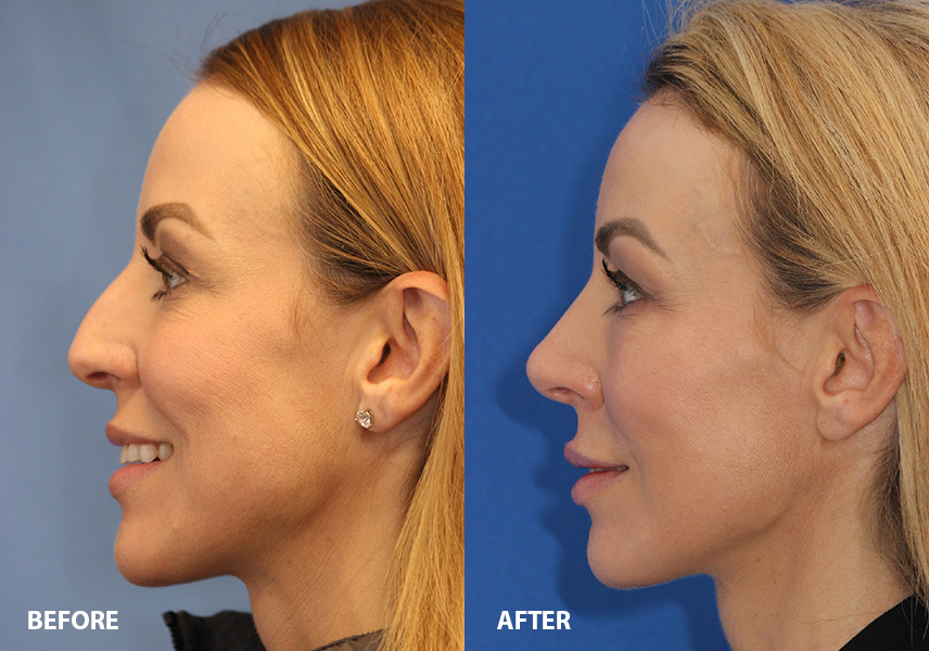 Rhinoplasty Before and After Photo by Ohio Facial Plastics in Dublin Ohio