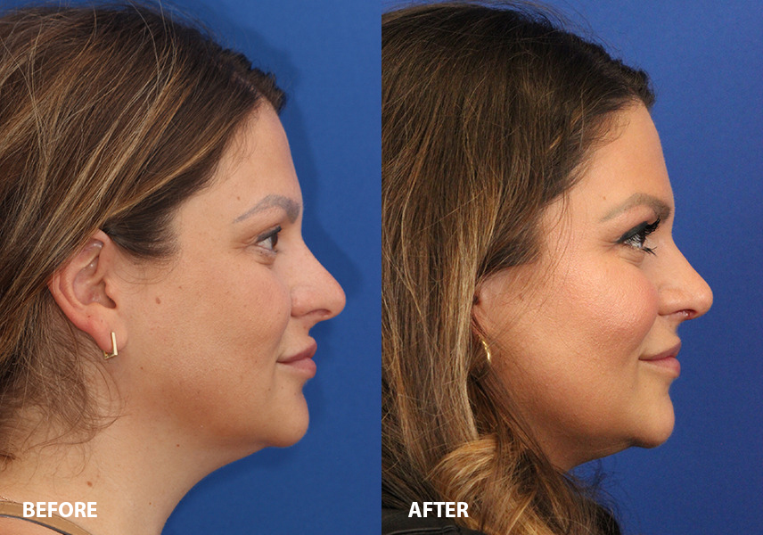Rhinoplasty Before and After Photo by Ohio Facial Plastics in Dublin Ohio