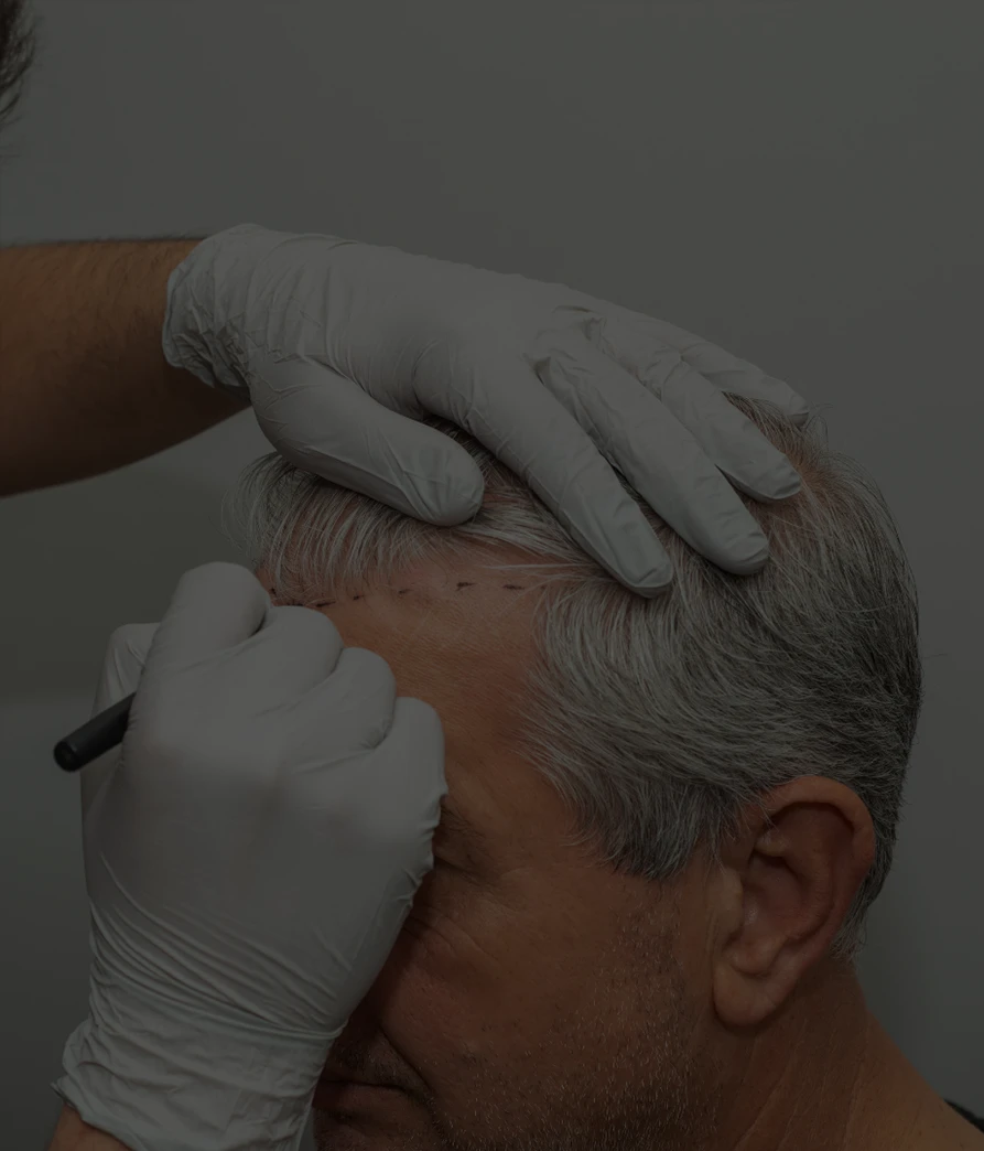 Forehead Reduction Surgeon Marking Male Patient's Hairline