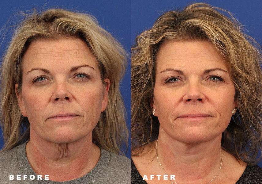 Photo of the patient’s Before & After the Facelift. Patient 6 - Set 3