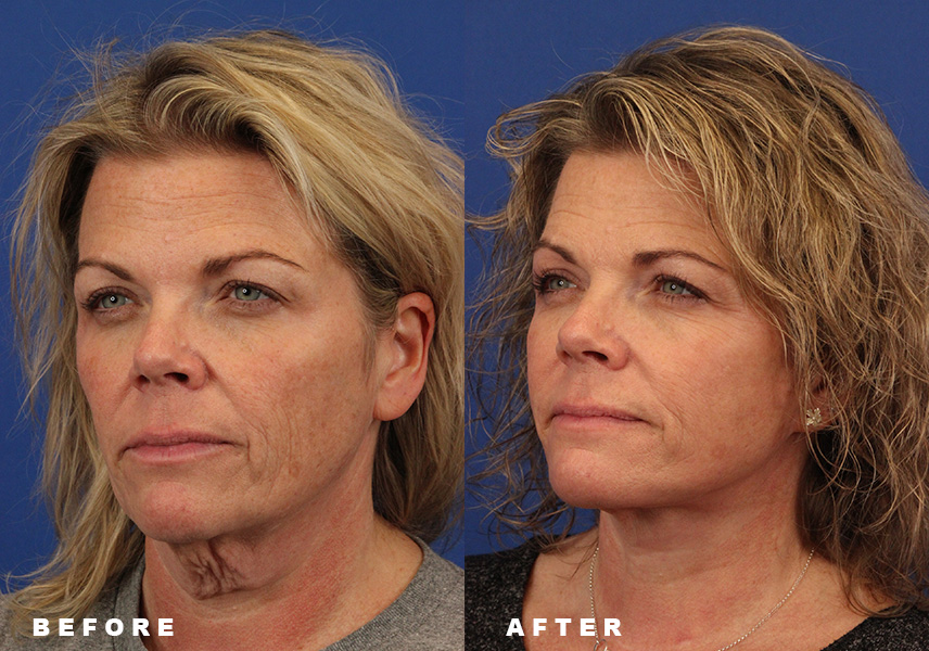 Photo of the patient’s Before & After the Facelift Patient 6 - Set 4