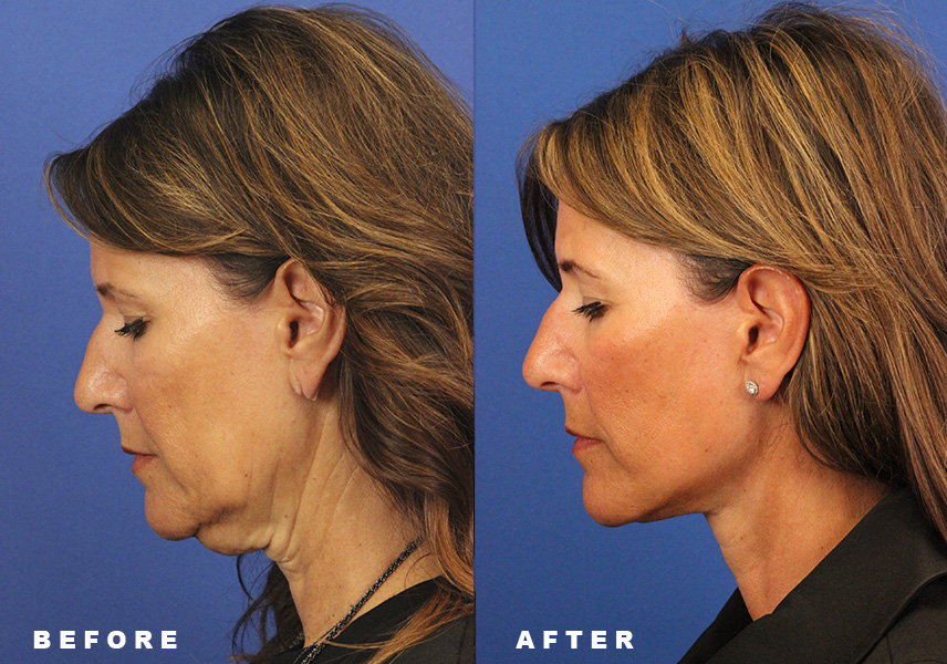Photo of the patient’s Before & After the Facelift Patient 7 - Set 6