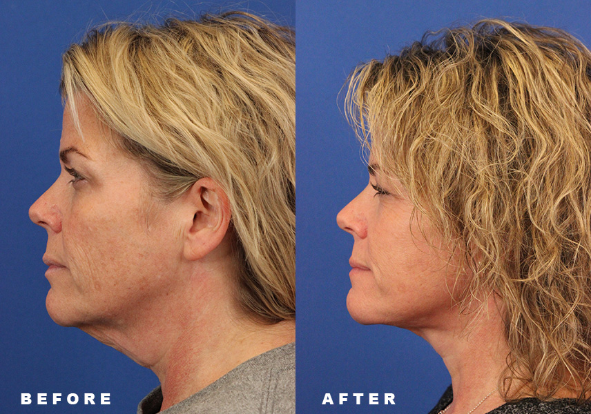 Photo of the patient’s Before & After the Facelift Patient 6 - Set 5