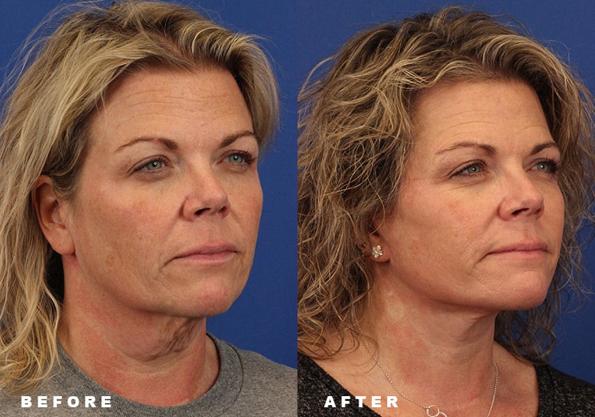Photo of the patient’s Before & After the Facelift. Patient 6 - Set 2