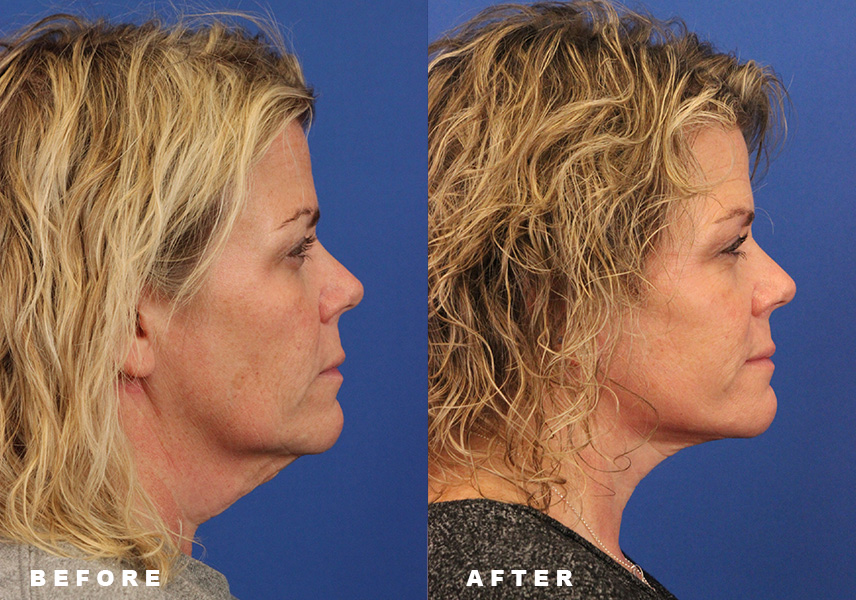 Photo of the patient’s Before & After the Facelift. Patient 6 - Set 1