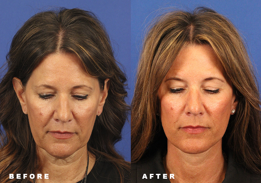 Photo of the patient’s Before & After the Facelift Patient 7 - Set 7