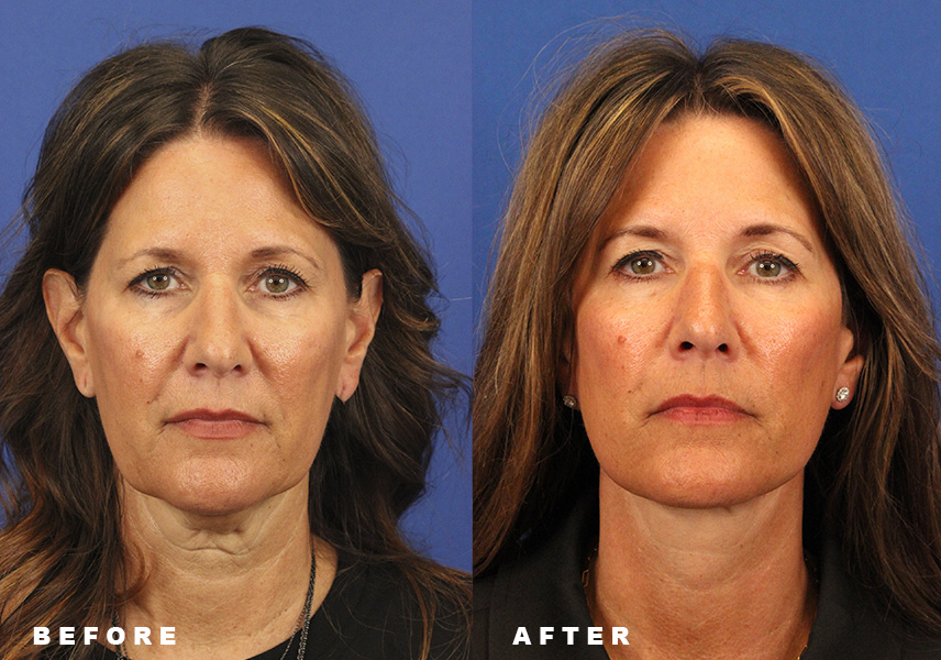 Photo of the patient’s Before & After the Facelift. Patient 7 - Set 3