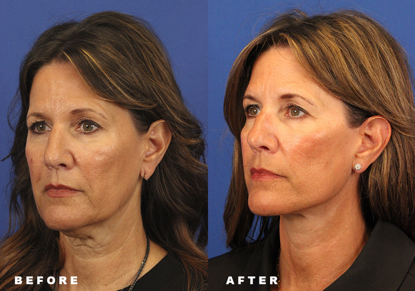 Photo of the patient’s Before & After the Facelift Patient 7 - Set 4