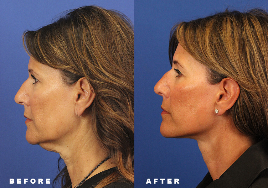 Photo of the patient’s Before & After the Facelift Patient 7 - Set 5