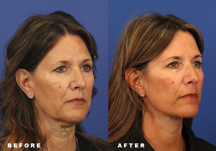 Photo of the patient’s Before & After the Facelift. Patient 7 - Set 2