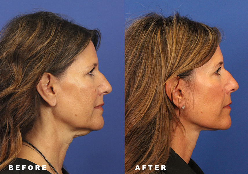 Photo of the patient’s Before & After the Facelift. Patient 7 - Set 1