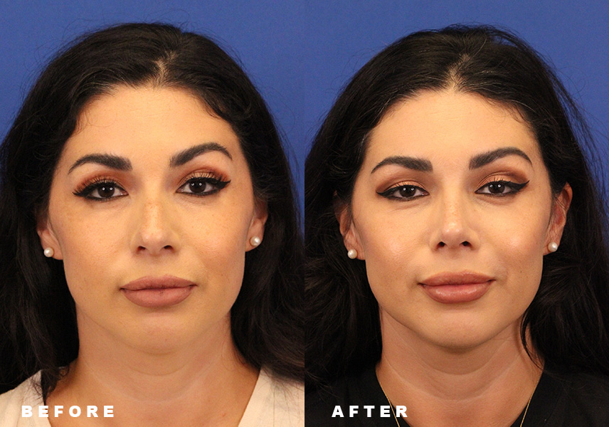 Thumbnail another photo of the patient’s Before & After. Patient 10