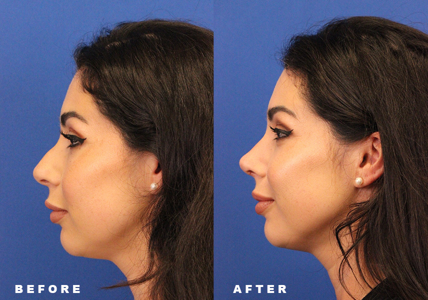 Photo of the patient’s Before & After the Rhinoplasty Patient 10 - Set 5
