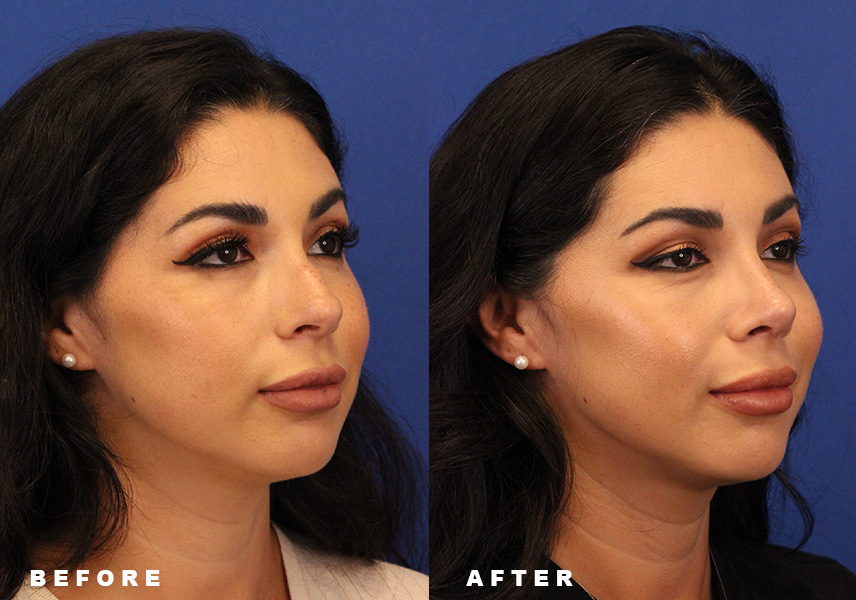 Photo of the patient’s Before & After the Rhinoplasty Patient 10 - Set 2