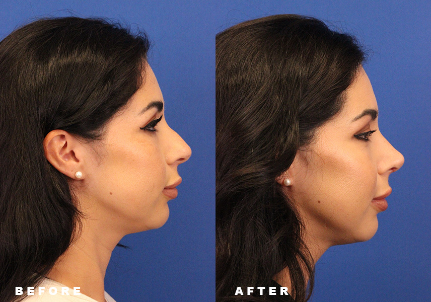 Photo of the patient’s Before & After the Rhinoplasty Patient 10 - Set 3