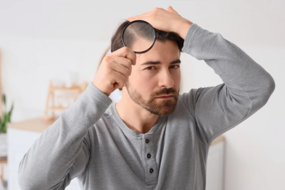 Man examining scalp with magnifying glass after hair transplant