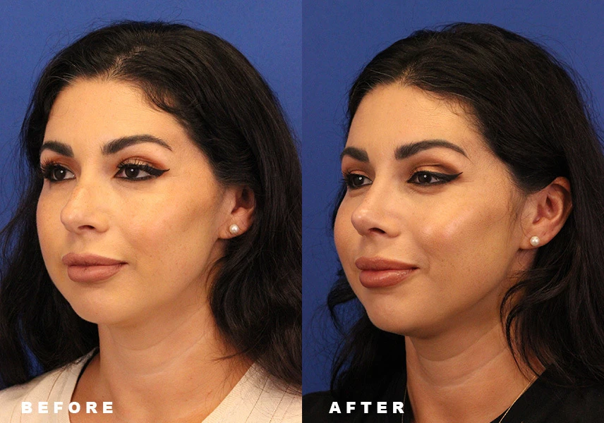 Ethnic rhinoplasty before and after comparison highlighting smoother nasal profile and enhanced symmetry in Dublin, Ohio