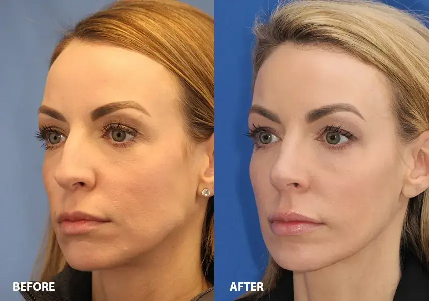 Rhinoplasty before and after nasal surgery results showing refined nose shape and improved facial balance in Dublin, Ohio