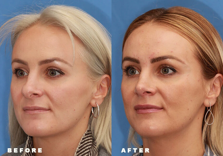 Revision rhinoplasty before and after Nasal surgery results showing improved nose contour and natural-looking outcome for patient in Dublin, Ohio