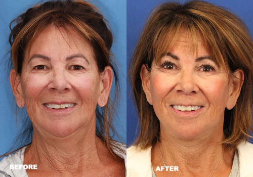 Before and after eye and brow surgery showing lifted eyelids and smoother forehead for a refreshed appearance in Dublin, Ohio