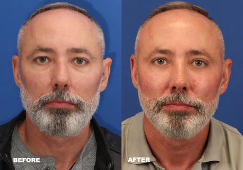 Blepharoplasty and brow lift results with improved eye openness and reduced sagging in Dublin, Ohio patient