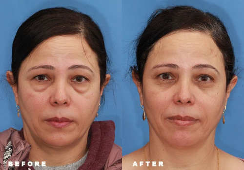 Eye and brow surgery transformation highlighting natural rejuvenation and brighter expression in Dublin, Ohio